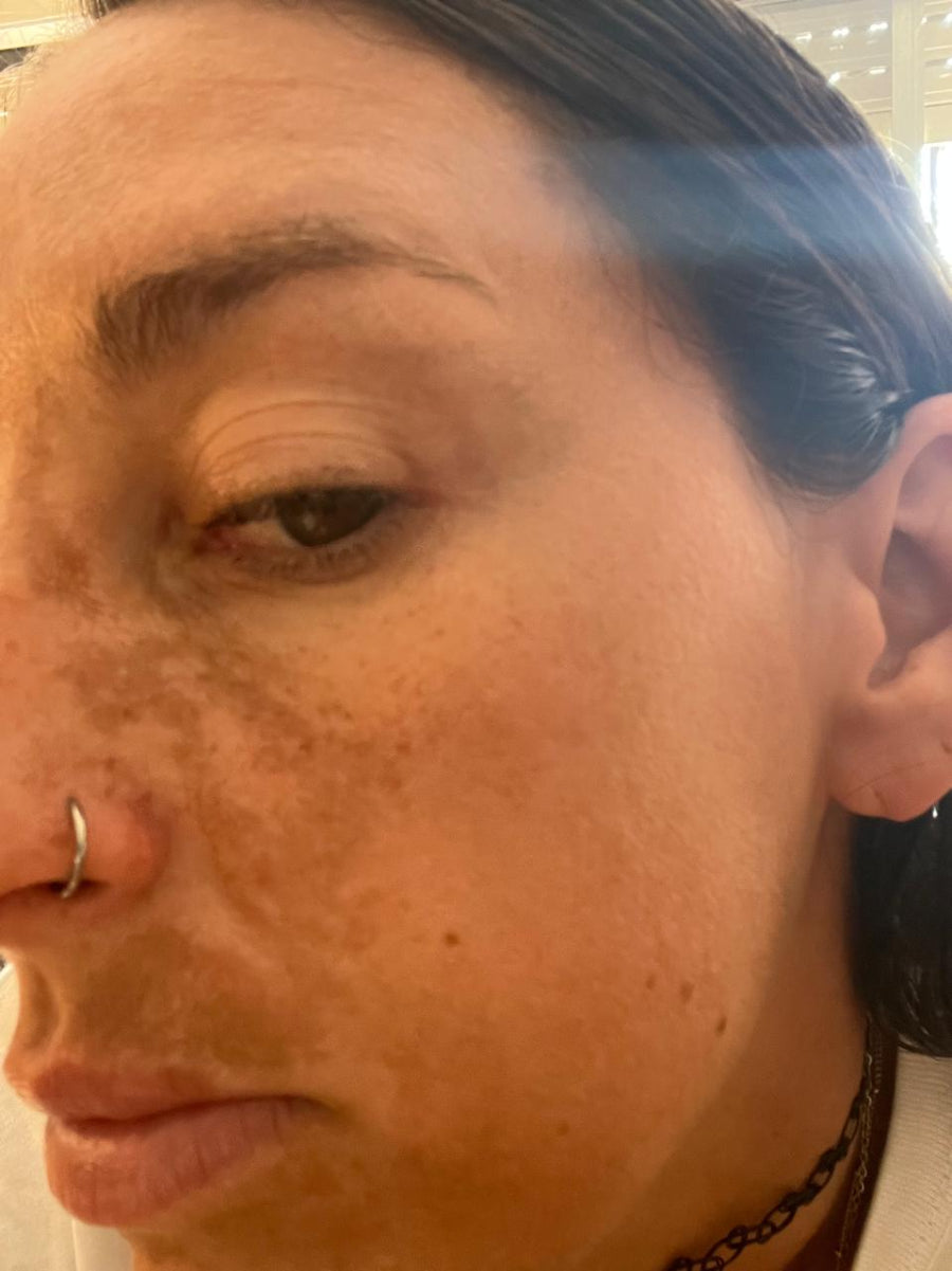 Protocolo de Raiz para Tratar el Melasma