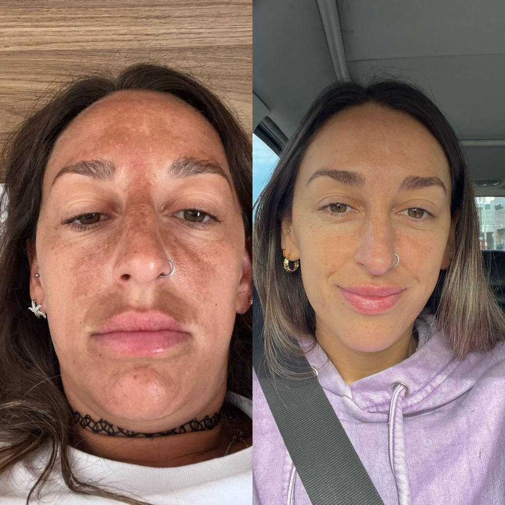 Protocolo de Raiz para Tratar el Melasma